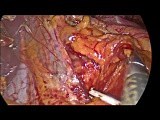 Gastric Volvulus, Laparoscopic Treatment • Video • MEDtube.net