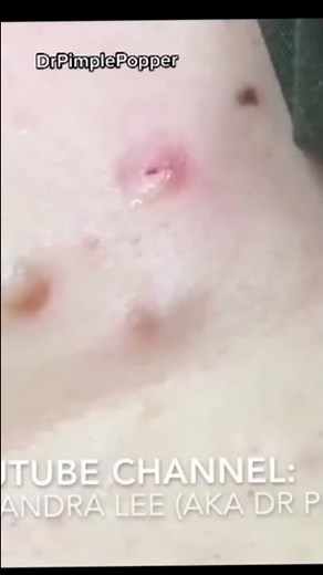 Do You Like Steatocystoma Lumps?