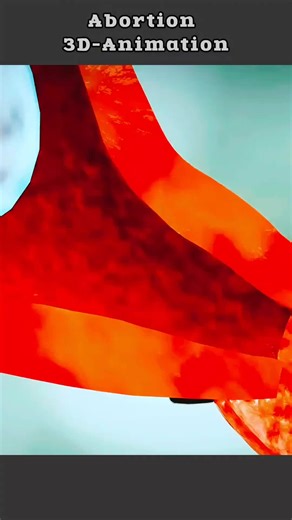 What Happens During An Abbortion? (3D Animation) #abortion #abortionprocess #birth #dilationandcurettage #abortionbaby