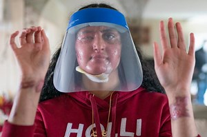 Acid attack Nafiah Ikram speaks to the Post about her encounter 
