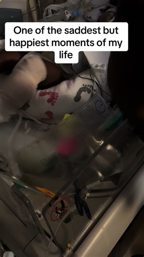 Micah was born with a rare birth defect called Tracheoesophageal Fistula (TEF)—a serious condition where the windpipe (trachea) and food pipe (esophagus) are abnormally connected. This causes severe feeding and breathing issues and requires surgery. The Lord allowed for my husband to help save his Life after delivery🙌🏽Here is my testimony. While Micah was still in my womb, the Lord sent me a dream. In that dream, the Lord warned me that Micah was not okay. Long story short, the day before my d