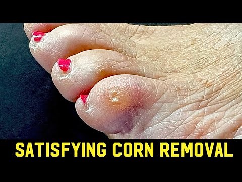 SATISFYING DEEP CORN REMOVAL ** FEELING STRESSED? SIT BACK & ENJOY!