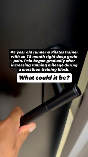 Answer was ⬇️⬇️⬇️⬇️⬇️⬇️⬇️ This hip had more than one thing going on. Diagnosis: • Anterosuperior labral tear with mild chondral wear • Cam morphology • Borderline dysplasia • Gluteus medius tendinopathy This pt had both intra articular issues (labral tear, cam morphology, possible instability from borderline dysplasia) and extra articular overload (gluteal tendinopathy). That combination changes how we rehab and when or if surgery is considered. Key points for this case: • Borderline dysplasia m