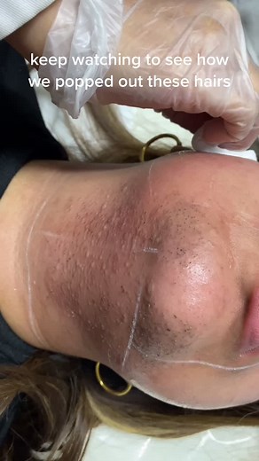 Remove Stubborn Hair with Medical Grade Laser