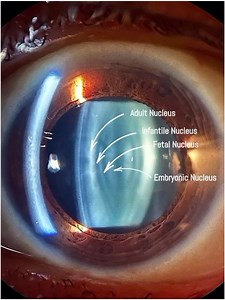 Human Crystalline Lens Anatomy. 📷: ophtalmocoach #retina #oftalmo #ophthalmology #oftalmologia #oftalmología #ophtalmologie #офтальмологія #офтальмология #οφθαλμολογία #ophthalmologists #eyehealth #vision #eye #zeissbrasil #visulasgreenbrasil #clarusbrasil #retinography #visulas #med #meded #eyedisease #medicalschool #medicalstudent #science #retina #neuro #instagram #coriorretinitis #retina #macula | OPTOMETRISTS