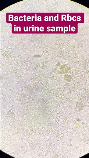 Bacteria and Rbcs in urine under microscope (40x view) #Pathology