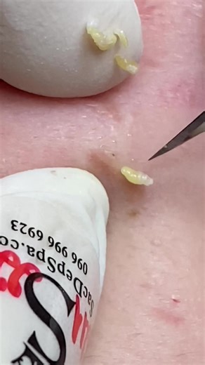 Lấy nốt nào xứng đáng nốt đó Cảnh báo video dài xem rất đã… #sacdepspa #truongthuy #pimple #trimungovap #xh