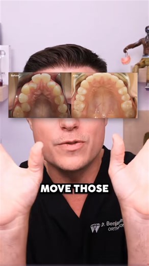 The craziest thing is how this device changes your jaw shape 😮🦷 #NationalFacialProtectionMonth #OrthoLife #TeethTransformation #BracesOff | TheBentistofficial