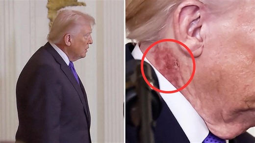 Roter Ausschlag an Trumps Hals sorgt für neue Spekulationen – Arzt nennt Grund