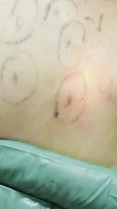 How We Can Remove CELLULITE!