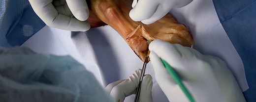 Es Amputación del primer dedo del pie izquierdo (rayo, cadáver) | Journal of Medical Insight