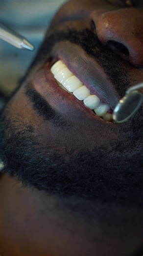 Discover the difference in your smile at Aliadent! 😁 Contact us now for a healthy, aesthetic, and natural smile. ✨ #healthyteeth #smiledesign #zirconium #dentalimplant #implantesdentales #implant #dentalclinic #dentalaesthetic #zirkoniumteeth #implantdentistry