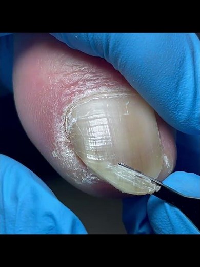 The oversized inlay armor was cut off #nails
