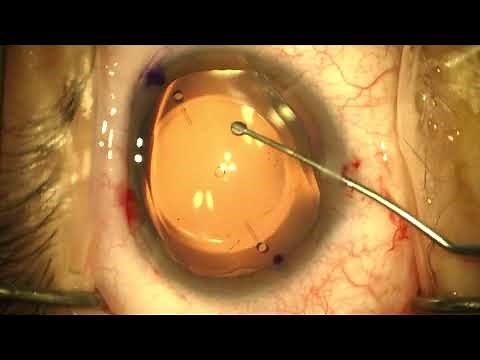 Toric implantable collamer lens (ICL) rotation