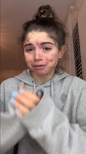 No one deserves acne ❤️ Go to TheAcneMethod.com if you need to get rid of your acne #acne #skincare