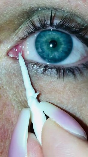 Satisfying Eye Mucus Removal: White String in Eye - Oddly Satisfying Video