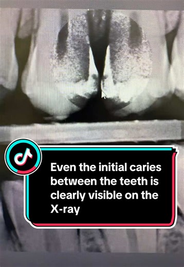 Understanding Initial Caries Through X-ray Analysis