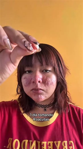 Quando eu era adolescente, era marcante pra mim o fato das pessoas nunca olharem nos meus olhos.Elas sempre contornavam meu rosto inteiro, reparavam em cada detalhe, e depois a reação se dividia entre nojo ou dó.Roacutan mudou radicalmente minha qualidade de vida.