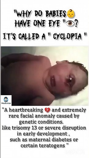 "Why do baby 👶 have one eye" 👁️|| CYCLOPIA