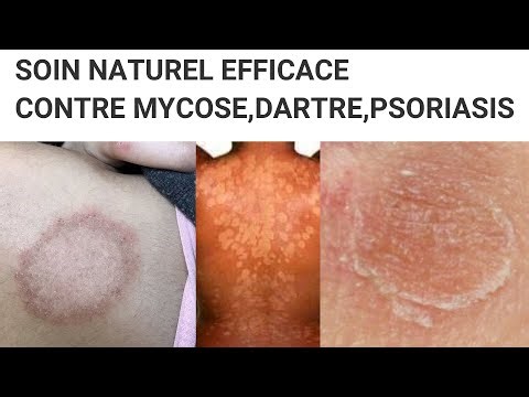 DEUX SOINS DE CHOC POUR SOIGNER ET GUERRIR LES MYCOSES, LA DARTRE ET LE PSORIASIS