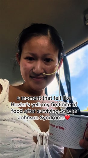 Understanding Steven Johnson Syndrome and Recovery