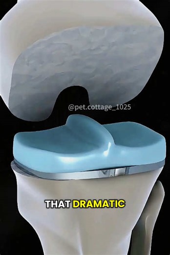 Total Knee Replacement Surgery Explained with Animation