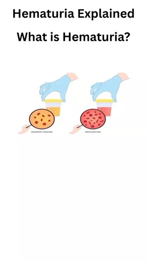Hematuria: What blood in urine means and why it should never be ignored. #Hematuria #Urinalysis #MedicalTerminology #LaboratoryScience #ClinicalDiagnosis #HealthcareEducation | Dominion Medical