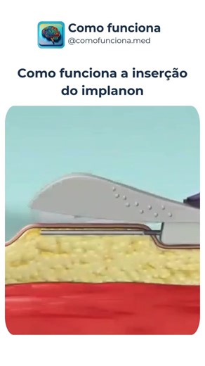 Como Funciona | Medicina | Como funciona a inserção do Implanon 👇💉 🔹 O Implanon é um pequeno bastonete colocado logo abaixo da pele 🔹 A aplicação é feita na parte... | Instagram