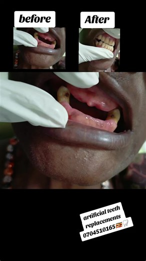 This video shows a treatment case of a removable partial denture ,our patient was missing her low front six teeth and almost all the upper first eight teeth were missing , we fabricated a removable partial denture for her and changed her smile. #foryoupage #goviral #artificialteeth #creatorsearchinsights #1millionaudition