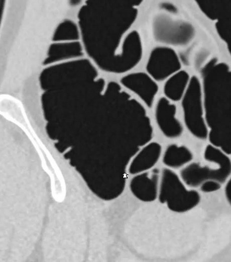 1cm polyp in the cecum