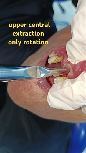 upper central extraction