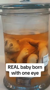 3.8K reactions · 205 shares | This is cyclopia and its pat vettiere spectrum of disorders called holoprosencephaly. Alobar holoprosencephaly explained. #neurosurgery #neurosurgeon #holoprosencephaly #holoprosencephalyawareness #cyclopia #oneye #geneticmutation #doctorexplains #medtok | Dr.Z Neurosurgery | Facebook