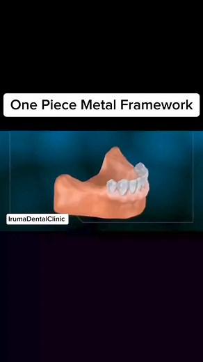 205K views · 991 reactions | These types of partials have a metal framework which holds the teeth together and is covered with an acrylic that mimics the esthetics of the gums. #fbreelsfypシ゚viralfbreelsfypシ゚viral #fbreelsfypシ゚viralシ #fbreels2024 #irumadentalclinic #docanneirumalinto #fbreelsfypシ゚ #oralknowledge #dentalknowledge #oralhealth #dentist #Dentures #onepieceframework #highlightseveryone #everyone | Iruma Dental Clinic | Facebook