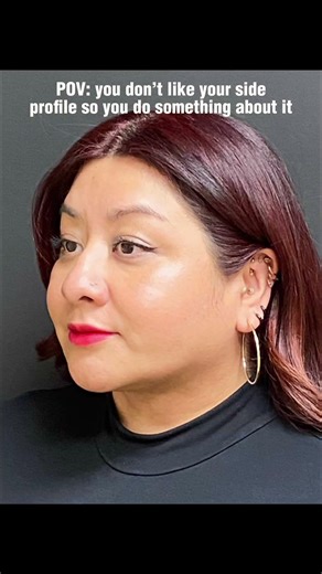 Chin liposuction before and after