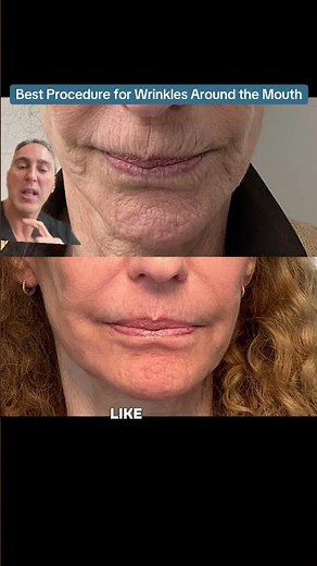 Best Procedure for Wrinkles Around the Mouth