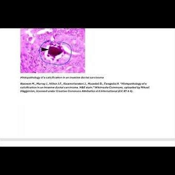 Dystrophic Calcification #medicaleducation #pathology #usmle #medical #medicalstudent #education