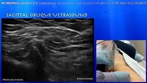 Hydrodissection with Cortisone Injection for Osteitis Pubis in a 76 Year Old Female