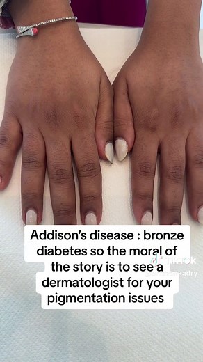 Understanding Pigmentation: Causes, Treatments, and More