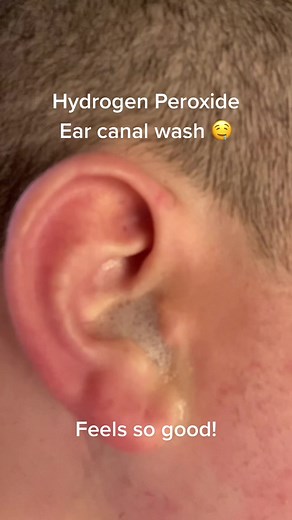 Ear Canal Wash with Hydrogen Peroxide for Cleansing