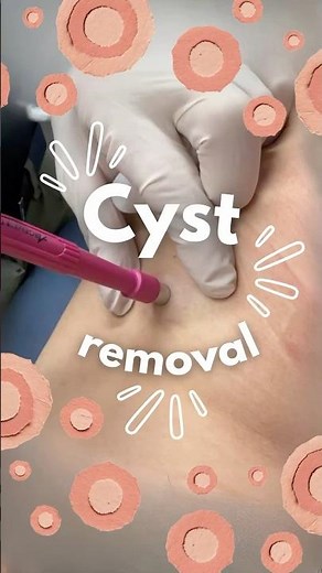 Cyst From An Old Injection Explained | Dr. Sullivan