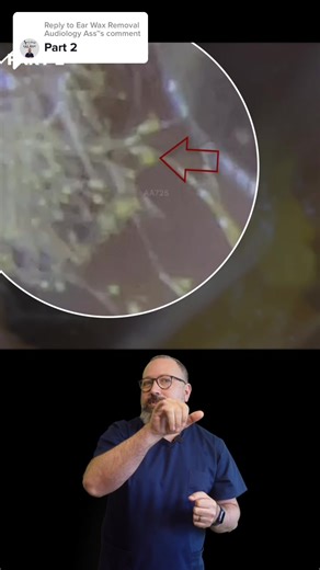 Fungal Ear Infection (Otomycosis) Removal Part 2