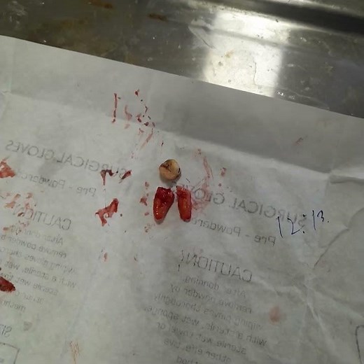 surgical extraction lower second molar by hemisection technique#