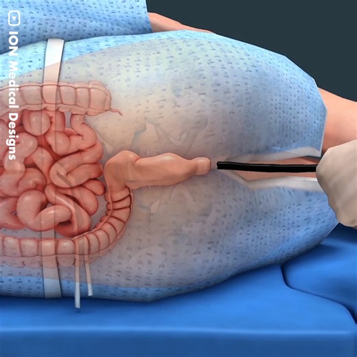 1.4M views · 9.3K reactions | This is how a colonoscopy is performed. A colonoscopy is an essential endoscopic exam that helps detect changes or abnormalities in the colon and rectum. It has been shown to be effective in preventing cancer and saving lives. | GIGadgets | Facebook