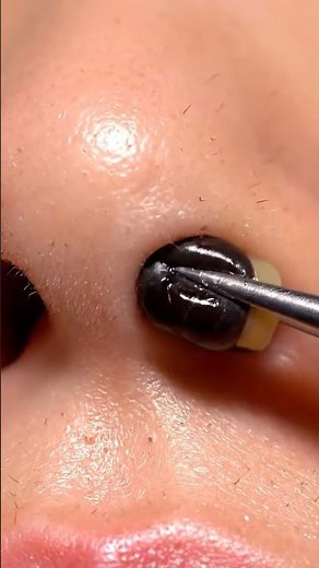 Precision Extraction! 🤏👃✨ #Tweezer #Extraction #Satisfying