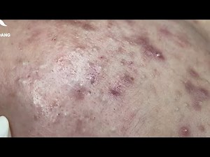Relaxing Acne Removal with Linh Mydang #578