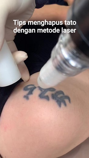 Edukasi Menghapus Tato dengan Teknik Laser Pendahuluan Menghapus tato dengan teknik laser adalah metode paling efektif dan aman dibandingkan dengan teknik lain seperti dermabrasi atau eksisi bedah. Laser tattoo removal bekerja dengan cara memecah partikel tinta di dalam kulit menggunakan sinar laser berkekuatan tinggi, sehingga partikel tersebut dapat dihilangkan secara alami oleh sistem limfatik tubuh. Metode ini membutuhkan beberapa sesi agar tato benar-benar hilang, tergantung pada faktor sep