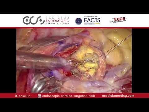 Totally Endoscopic TAVR Explantation