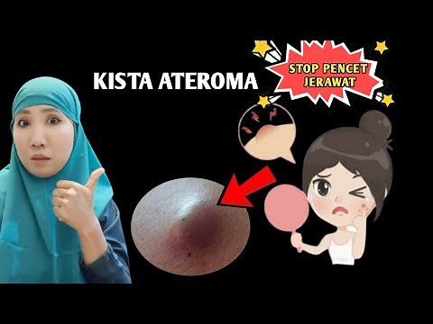 Kenapa bisa Mengalami jenis kista ateroma ini ||gejala, penyebab dan penanganan kista ateroma