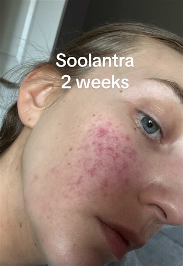 Soolantra: Tips for Managing Rosacea Symptoms