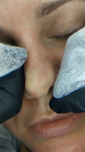 Professional Nose Pore Cleansing | Close-Up Skincare Treatment 👃✨